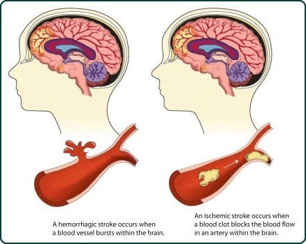 The diagram shows the different types of brain strokes.