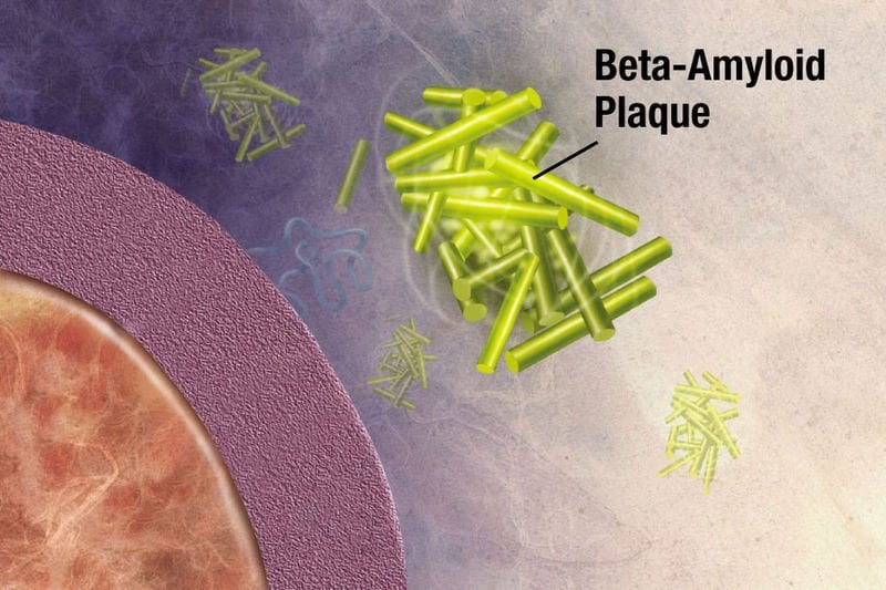 This image shows amyloid beta plaques associated with Alzheimer's disease.