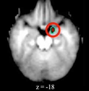 The fMRI image shows the elevated activity in the amygdala in children with depression.