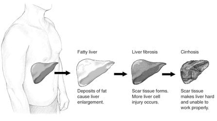 The image shows the different stages of liver damage.