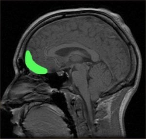 This brain scan shows the location of the orbitofrontal cortex.