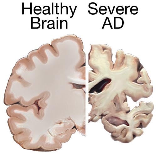 The image shows two different brain slices, one of a healthy brain and one of a brain with severe AD.