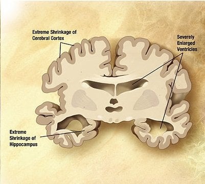 The image shows damage to the brain in an Alzheimer's patient.