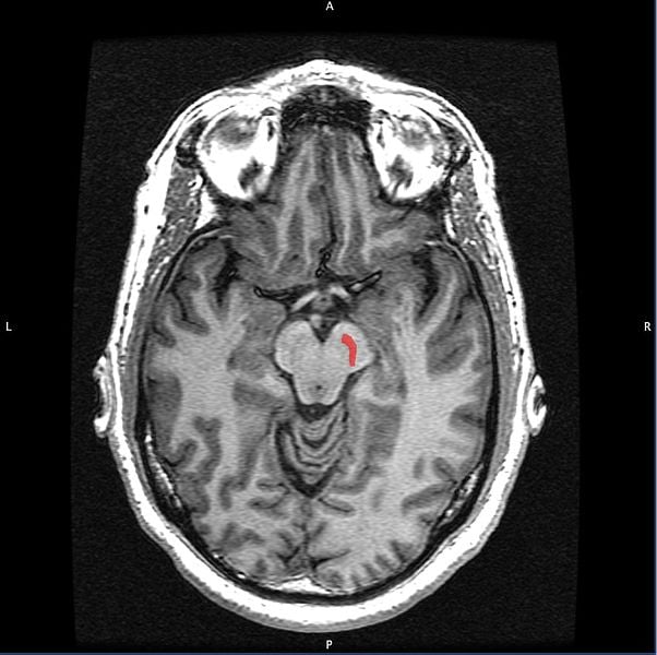 This MRI scan shows the location of the substantia nigra in the brain.