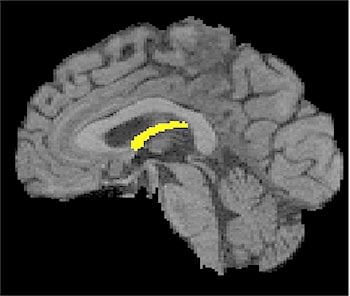A brain showing the fornix structure highlighted.
