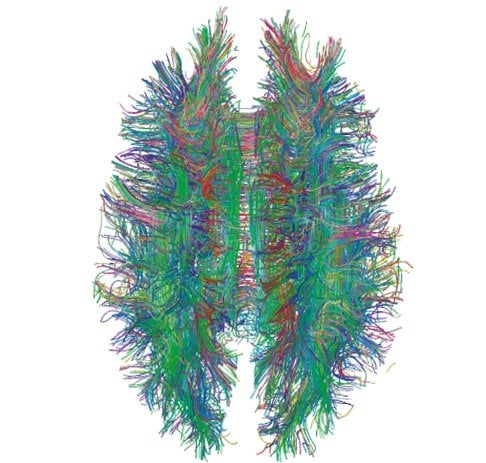 This image is a diffusion MRI tractography of the brain's white matter.