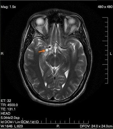 The image shows an MRI scan of a male patient with a low grade glioma.