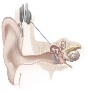 This is an illustration of a cochlear implant.