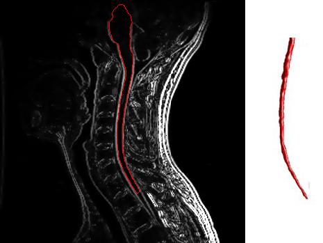 The image is a cervical spine MRI with enhancement showing multiple sclerosis.