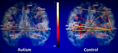 The image shows the brain scan results for autism associated with the research.