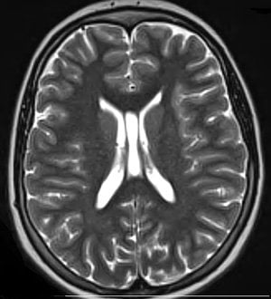 This is an MRI scan of a brain with concussion.