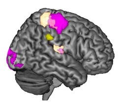 This is an MRI of the right brain hemisphere.