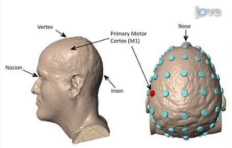 The image shows the areas of the brain targeted.