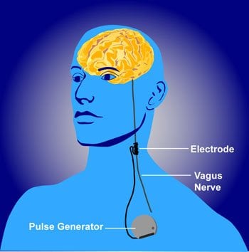 Vagus Nerve Stimulator (VNS) Implants