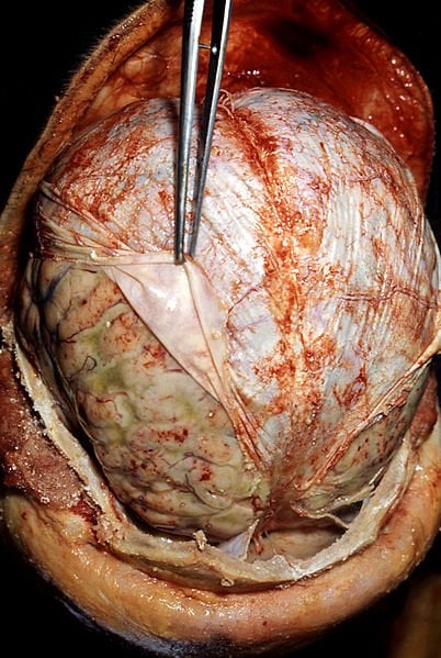 This shows an autopsy of a brain with meningitis.