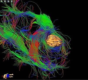 diffusion tensor imaging News Research Articles