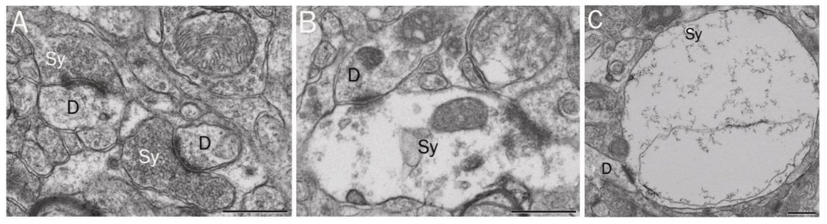 The image shows synaptic degeneration.