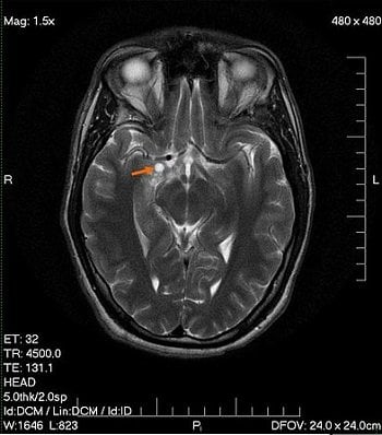 This is an MRI scan of a brain with a glioma.