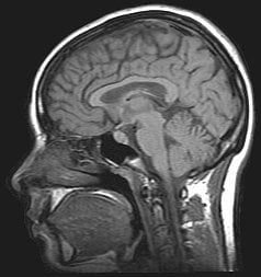 This is an MRI brain scan.