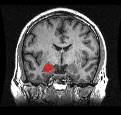 This mri scan shows the location of the amygdala.