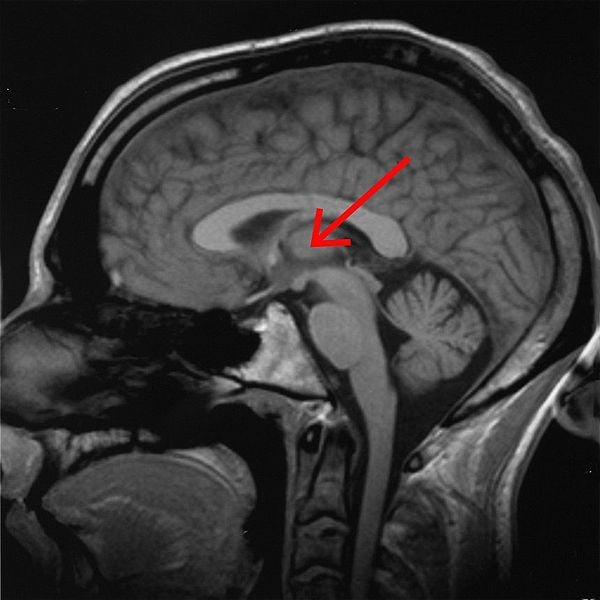 This mri scan shows the location of the thalamus.