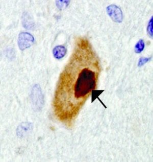 The image shows motor neurons in an ALS patient.