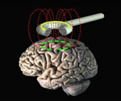 The image shows tms being applied to the brain.