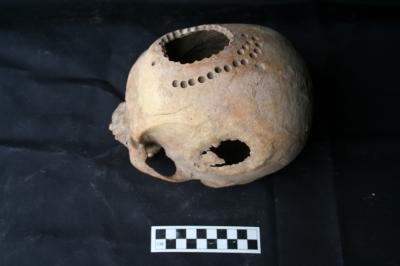 This is a trepanned skull with new bone growth.