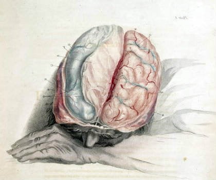 The image shows a sleeping man with an exposed brain.