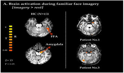 This is an fMRI of a patient in a vegetative state.