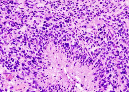 Histopathological image of cerebral glioblastoma. Hematoxylin & esoin stain.