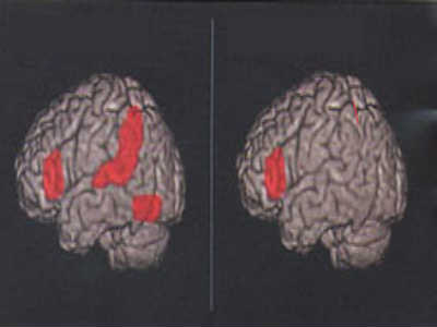 These are MRI scans of the brain of a person with dyslexia.