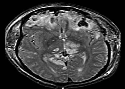 MRI of patient with brain trauma and resultant brain herniation.