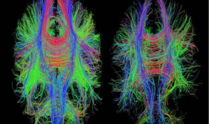These scans show the difference in white matter in the brain following TBI.