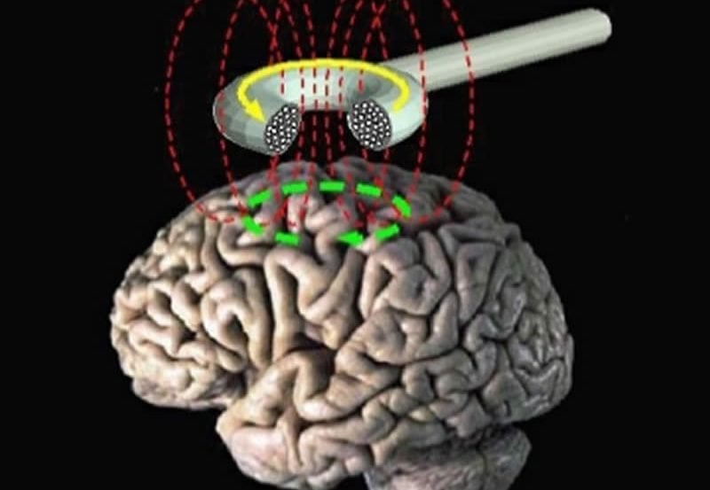 The image shows a brain with a diagram of a TMS machine placed above it.