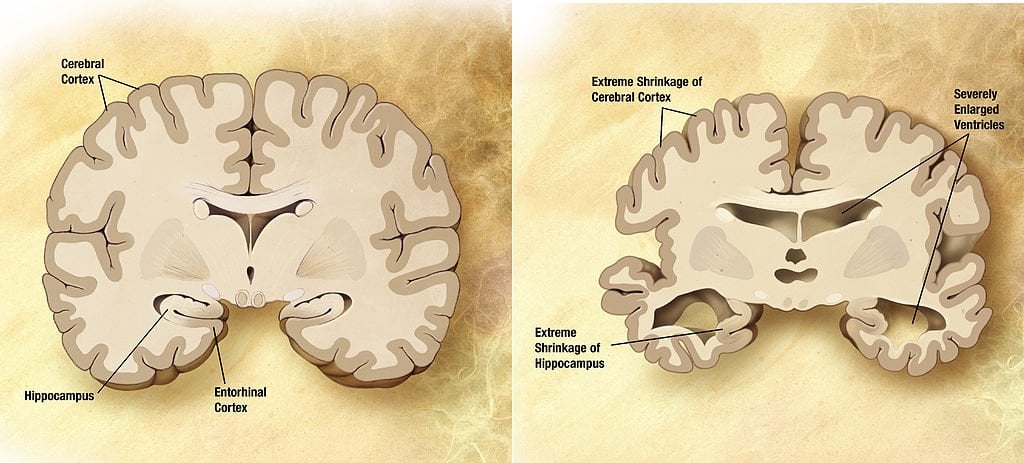 This shows the difference between a healthy brain and one of an alzheimer's patient.