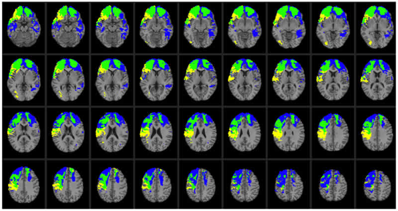 This image shows MRI scans takes from the research paper.