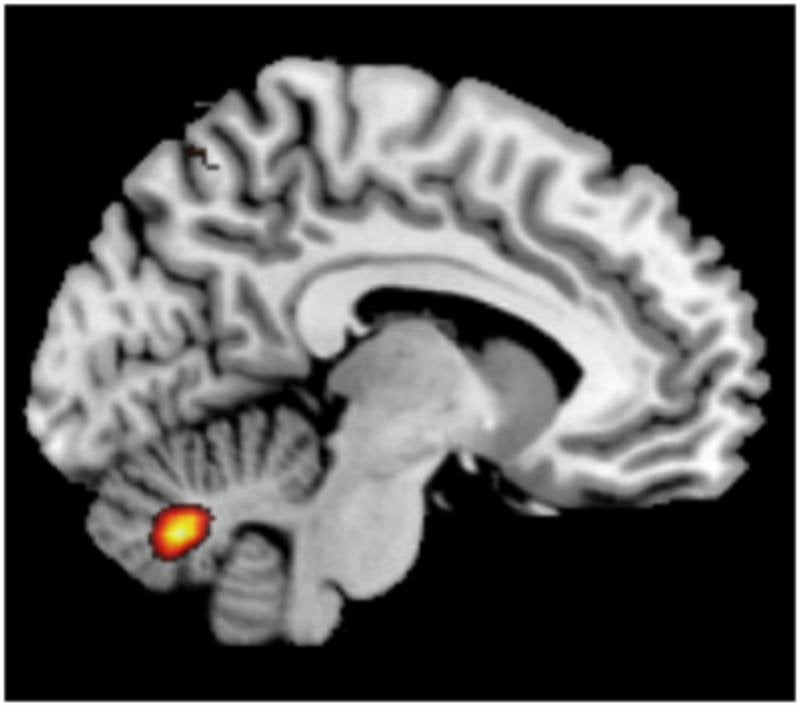 This is an fMRI scan which shows the location of the cerebellum in a schizophrenic patient.