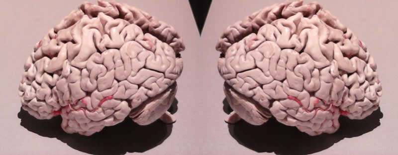 This image shows plastinated brains with alzheimers.