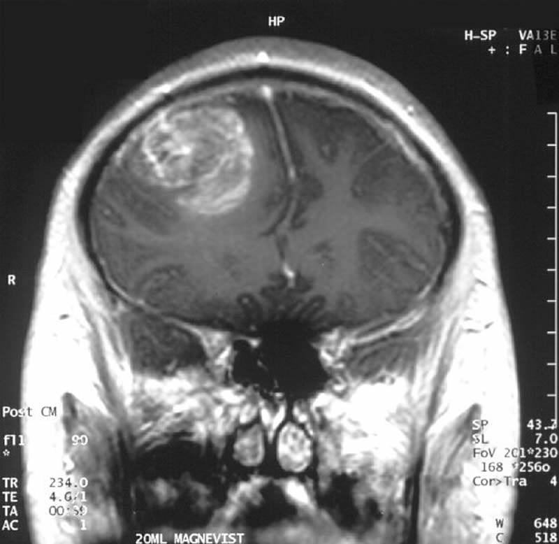 This is a brain scan of a patient with glioblastoma brain cancer.
