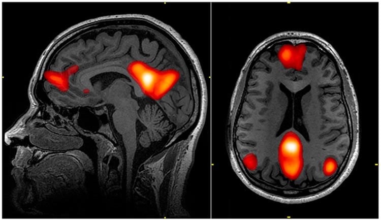 This image shows an MRI of the default mode network in the brain.