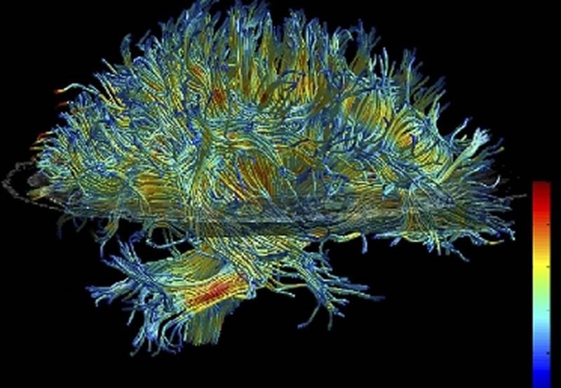 This is a dti scan image of white matter in the brain.