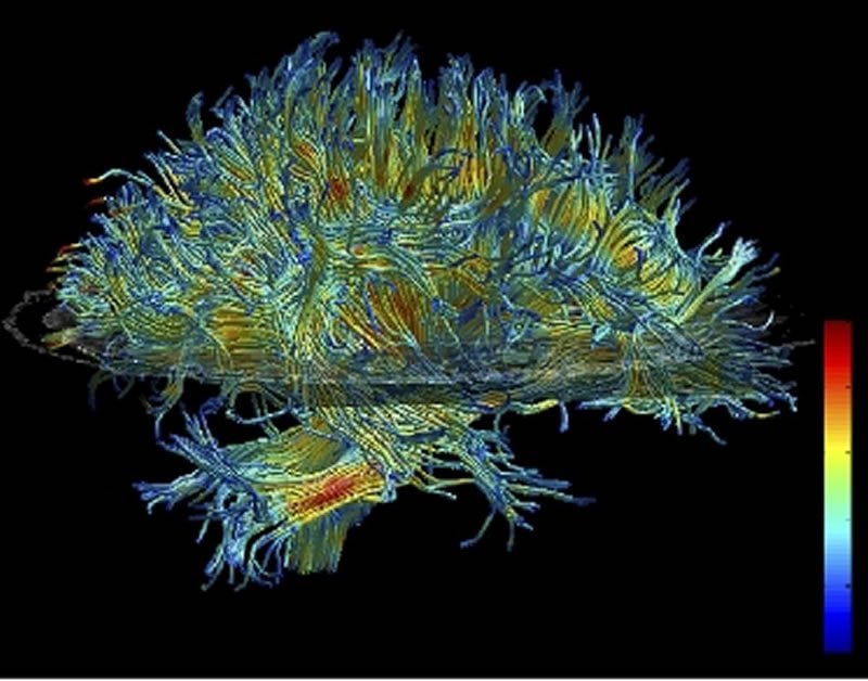 This is a dti scan image of white matter in the brain.