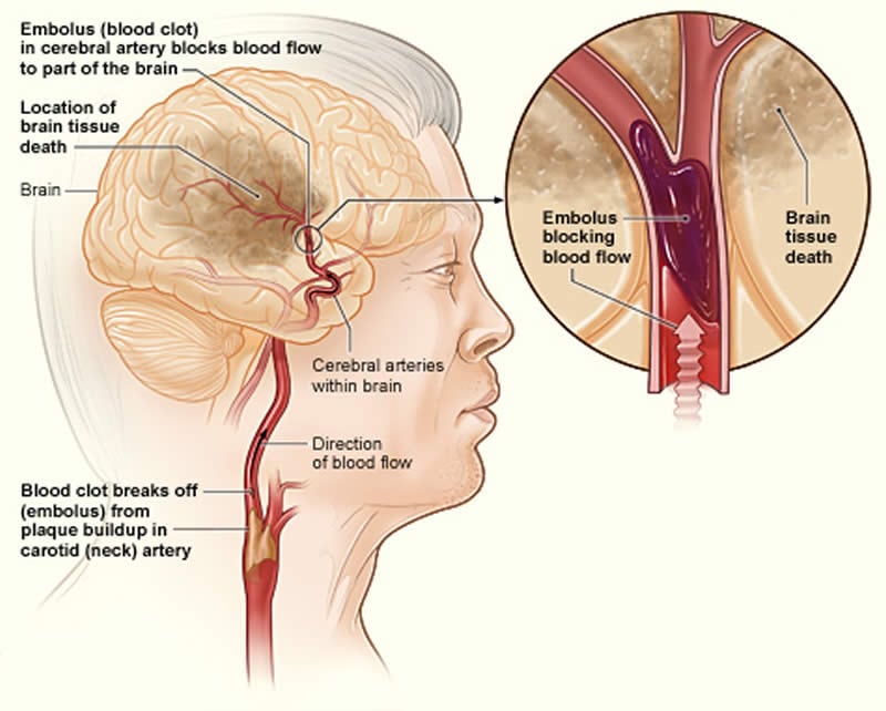 image shows how an ischemic stroke can occur in the brain.