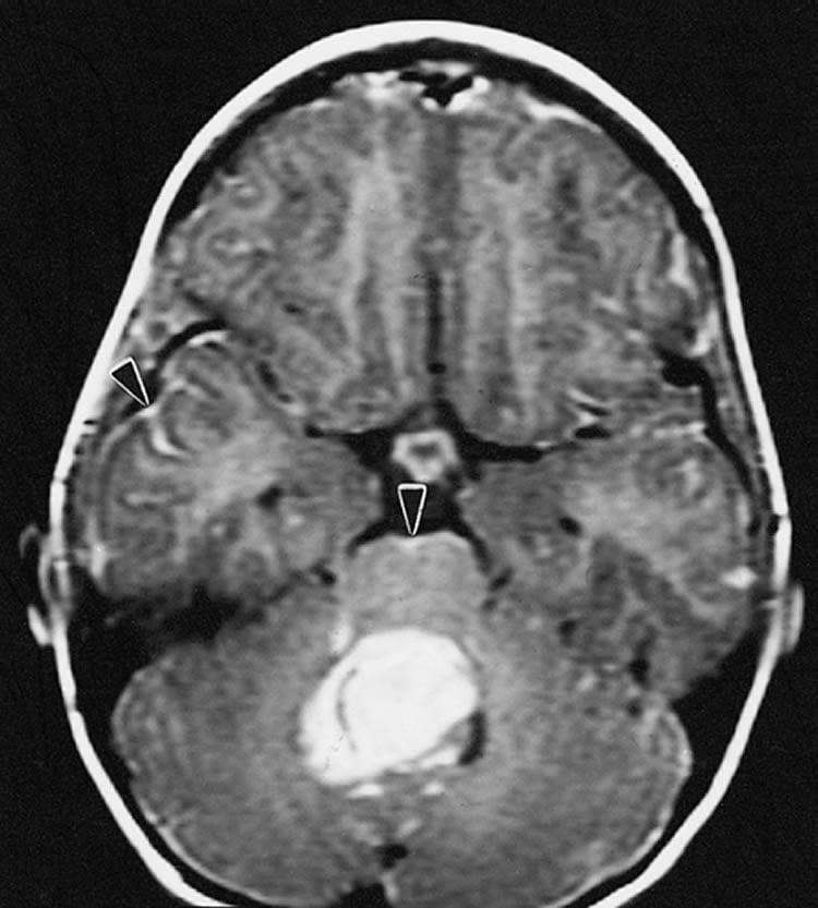 This image shows the location of a medulloblastoma brain tumor.