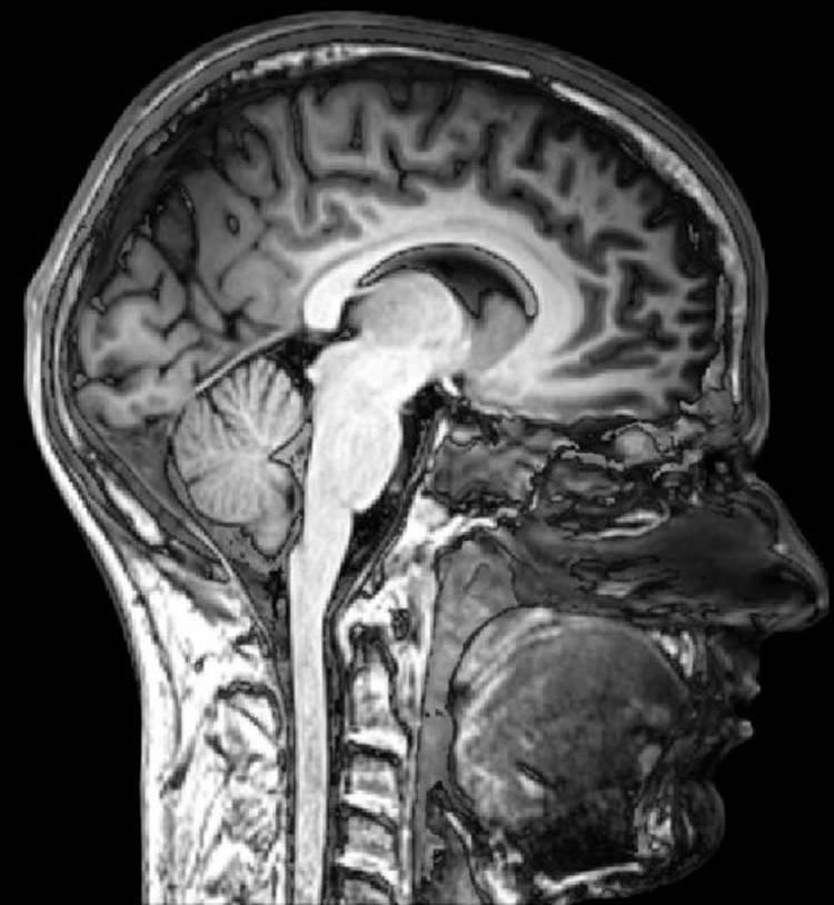 This MRI scan shows a sagital view of the human head.