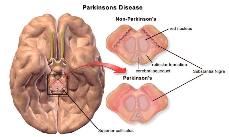 This image shows the differences in superior colliculus between Parkinson's patients and those without the disease.