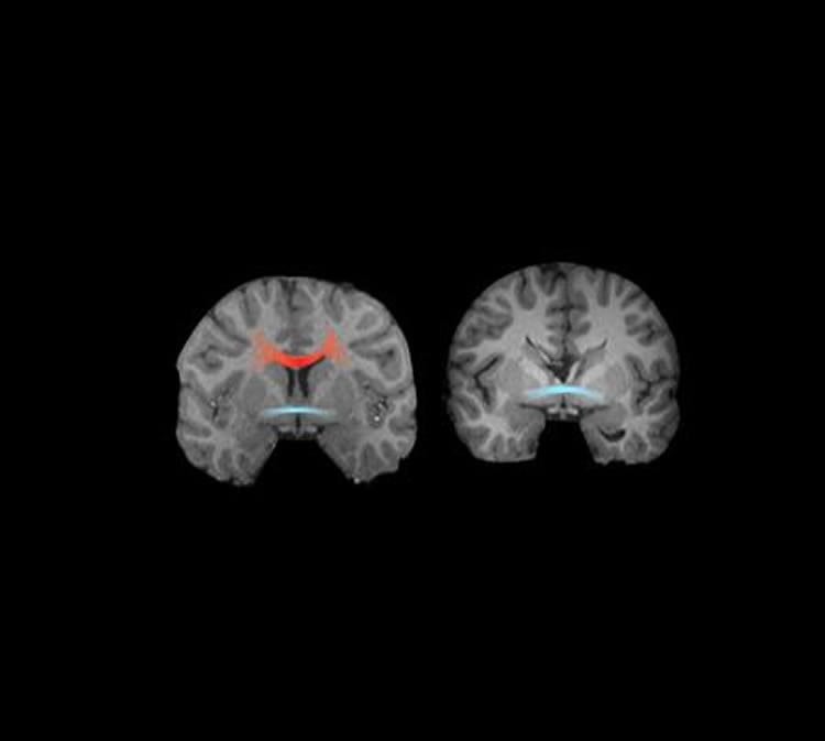 This shows MRI images from a neurotypical control (left) and an adult with complete agenesis of the corpus callosum (right).