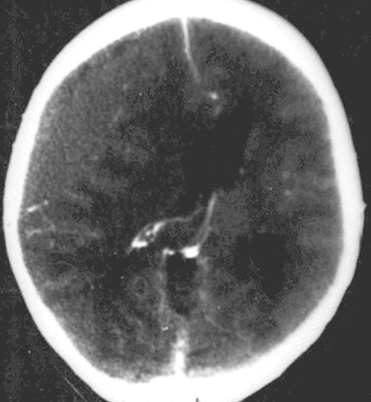 This image shows a CT scan of a epidural hematoma.