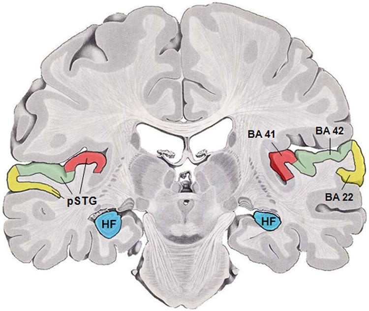 The image shows a coronal section of a human brain. BA41(red) and BA42(green) are primary auditory cortex.